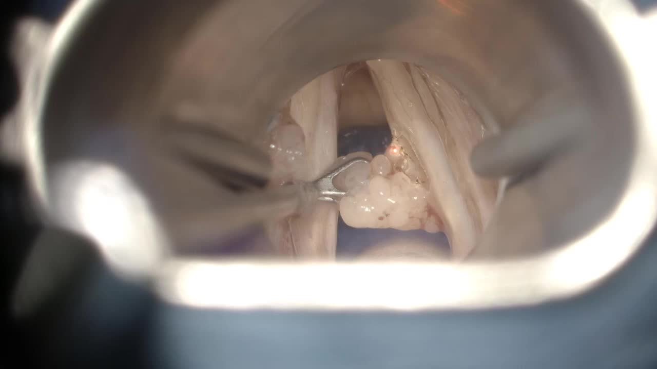 Papilloma resection right vocal cord