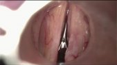 Leukoplakia of the right vocal fold. Cordectomy type I