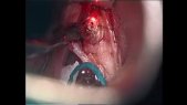 Type I cordectomy and previous assessment without endotracheal tube