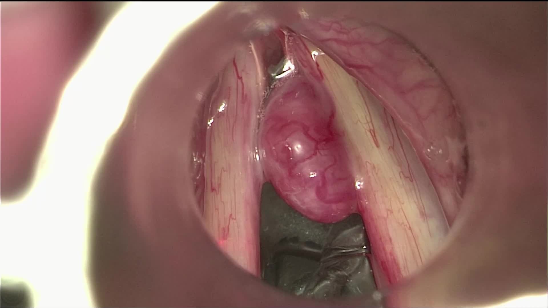 Hemorrhagic polyp of the right vocal fold