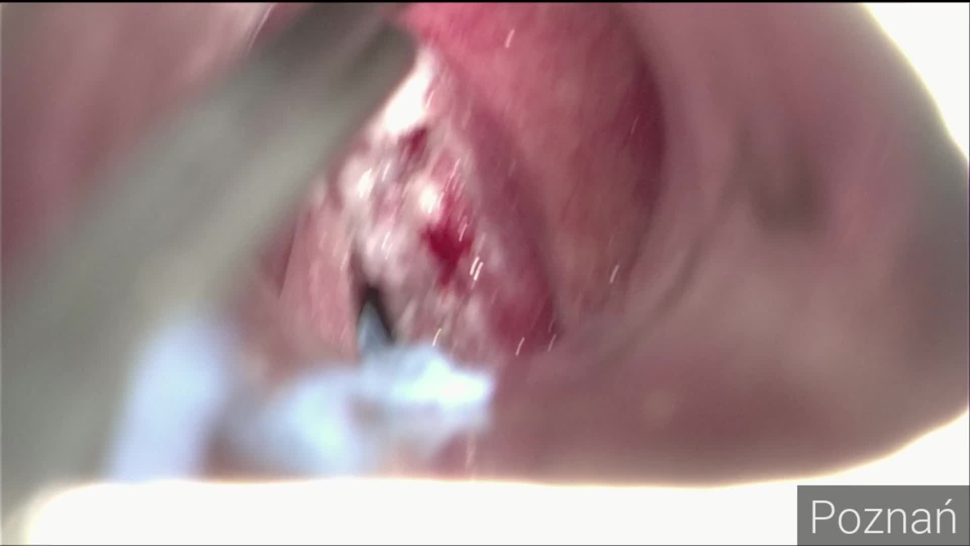 Tumor of the right vocal fold. Cordectomy type V