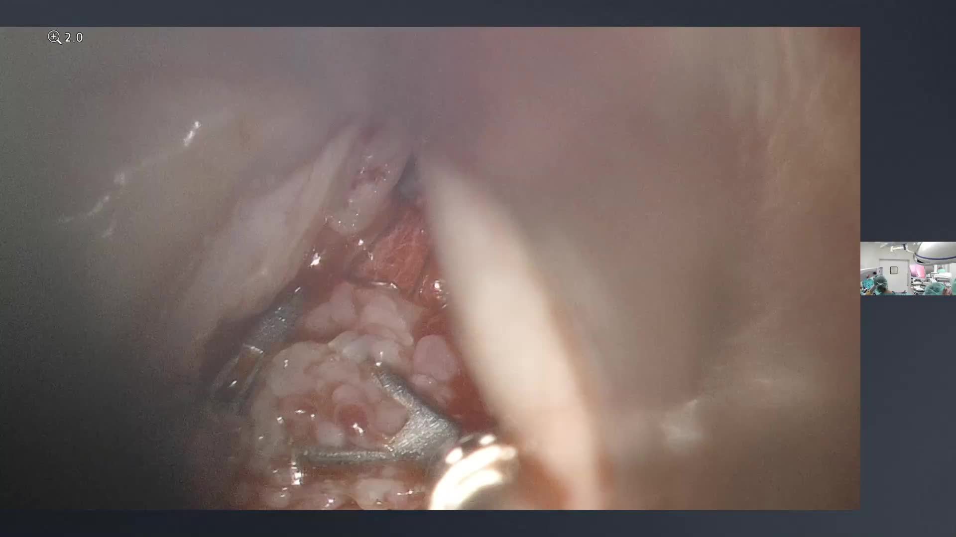 Laryngeal papillomatosis with dysplasia
