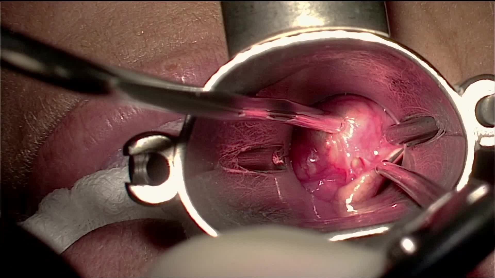 Resection of vallecular cyst