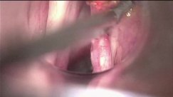Tumor of the right vocal fold. Cordectomy type II