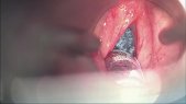 Posterior cordotomy due to glottic stenosis