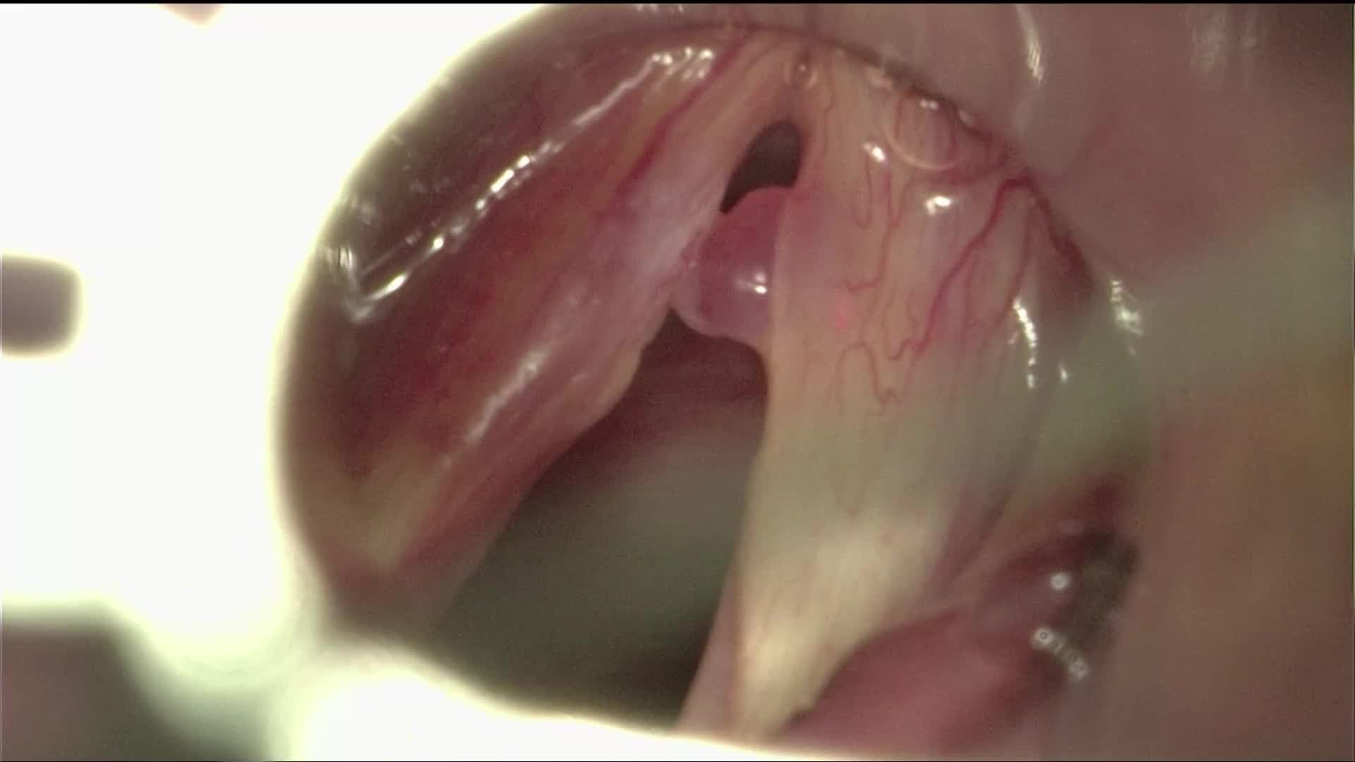 Polyp of the right vocal fold 