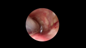 6 weeks follow up after cordectomy IV right vocal cord