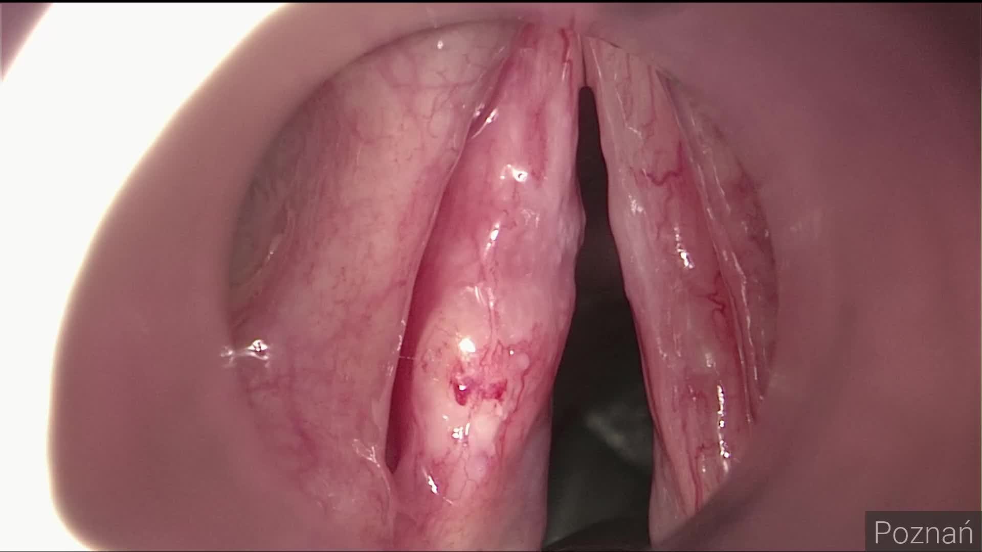 Tumor of the left vocal fold. Cordectomy type II