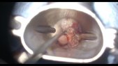 Vallecula cyst resection