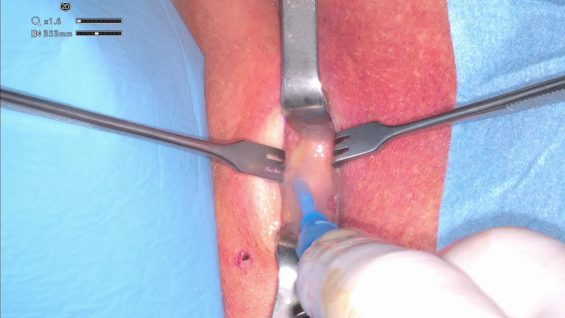 Tracheostomy under local anesthesia