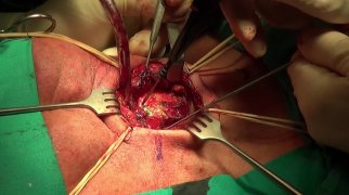 Resection of a chondroma of the thyroid cartilage