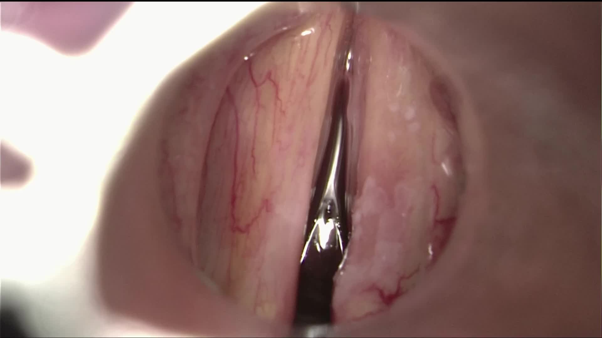 Leukoplakia of the right vocal fold. Cordectomy type I