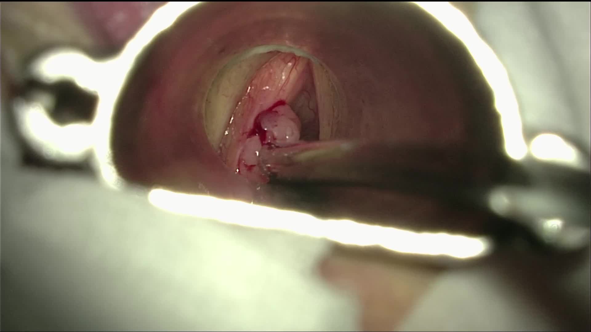 Tumor of the left vocal fold. Cordectomy type II