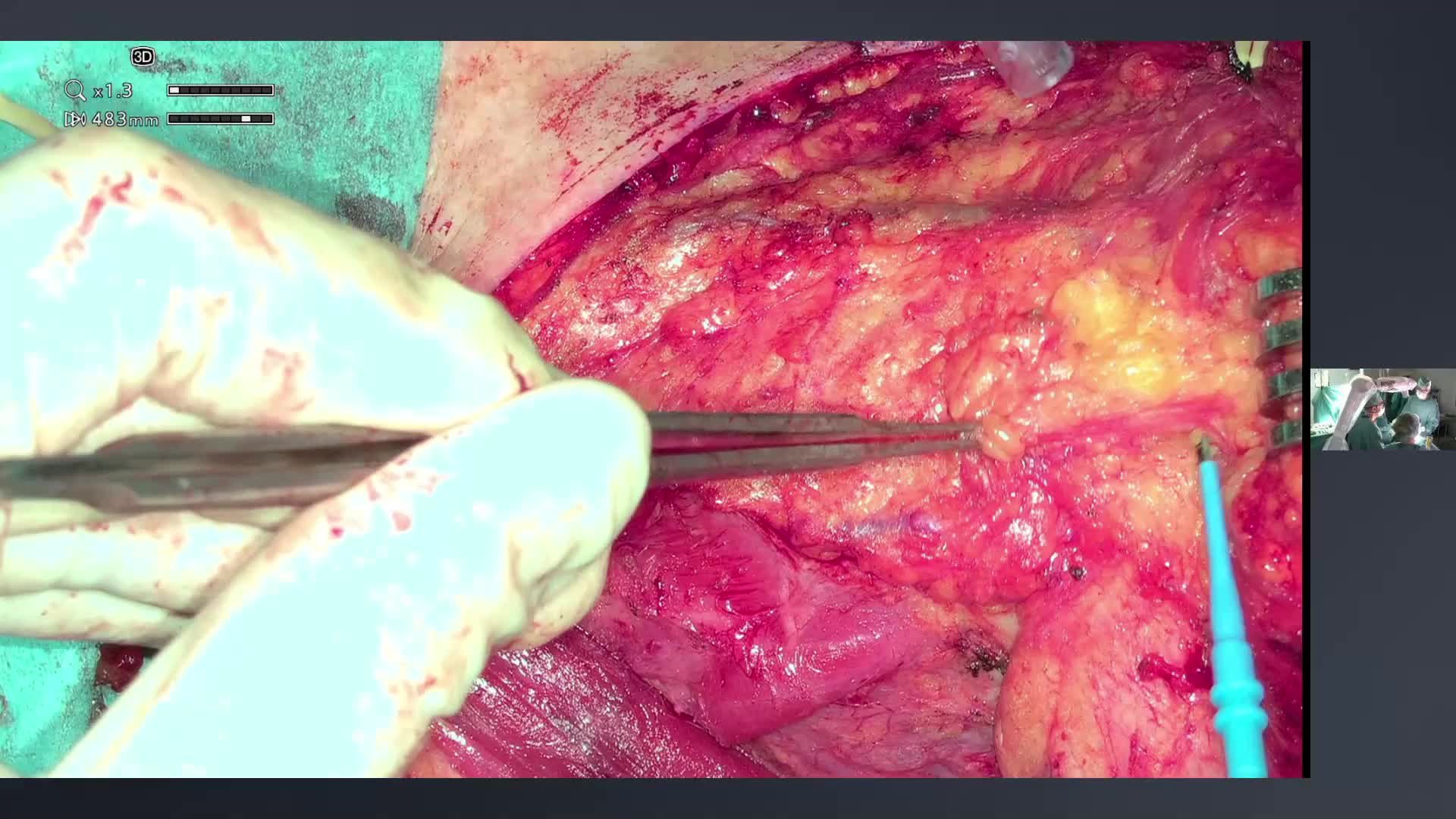 Total laryngectomy with Endo GIA closure