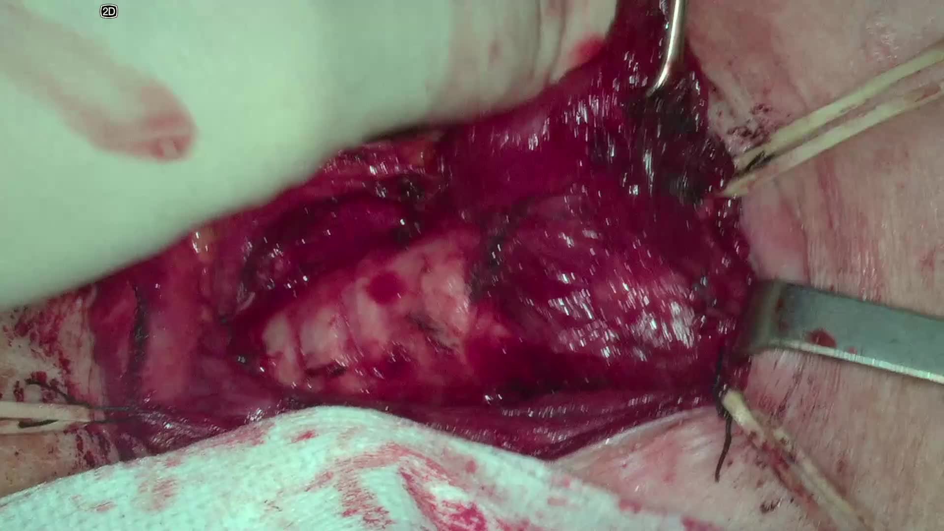 Medialization thyroplasty under general anesthesia