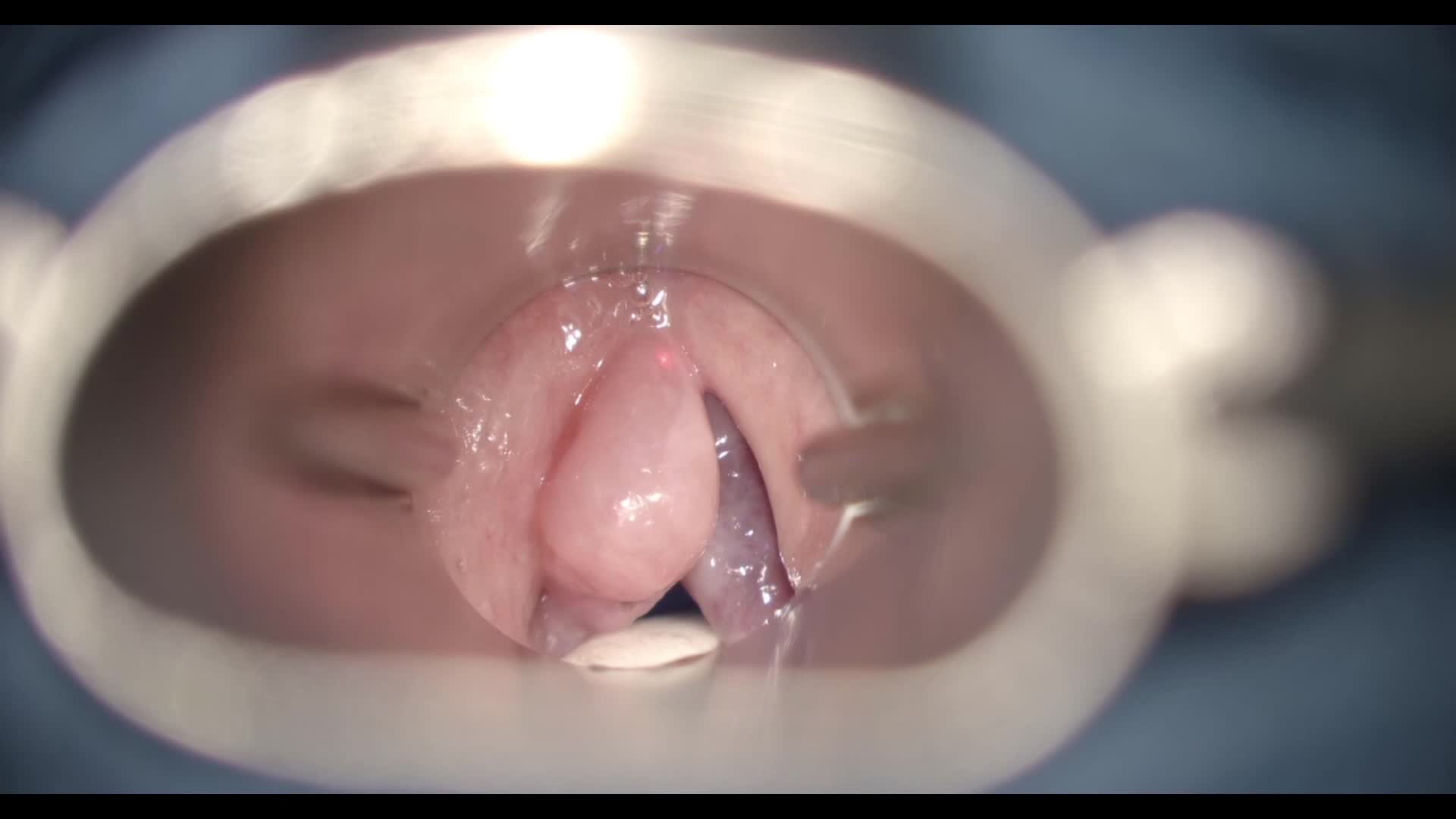 Polyp of the left vocal cord