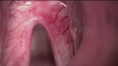 Second look cordectomy of the left vocal fold