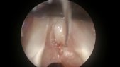 Dilation of an idiopathic subglottic stenosis