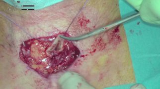 Tracheostomy closure