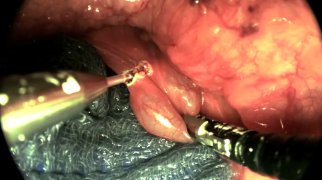 Epiglottic cyst