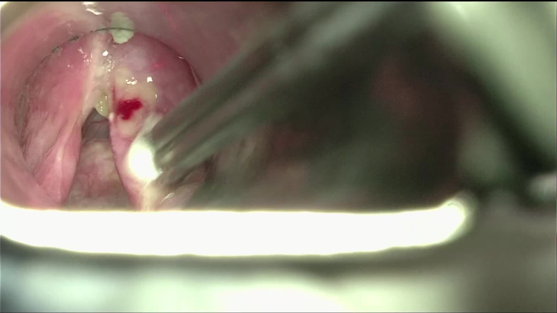 Tumor of the right vocal fold. Cordectomy type II. SSTOLM
