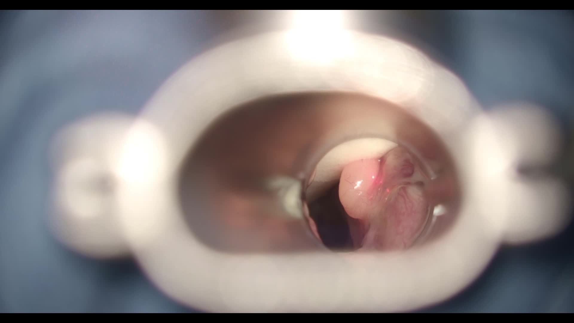 Polyp of the posterior vocal cord