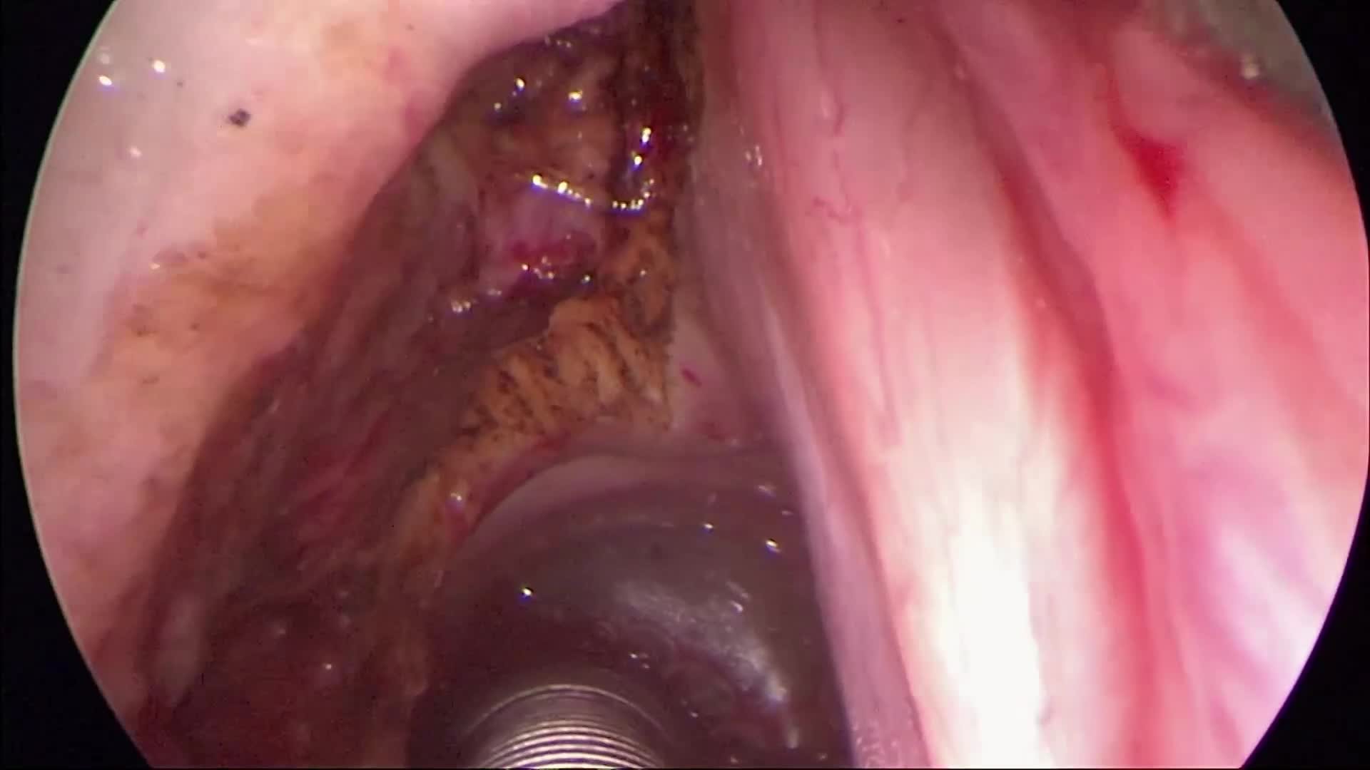 Cordectomy type III of the left vocal cord