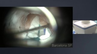 Resection of eventration of mucosa of the ventricle