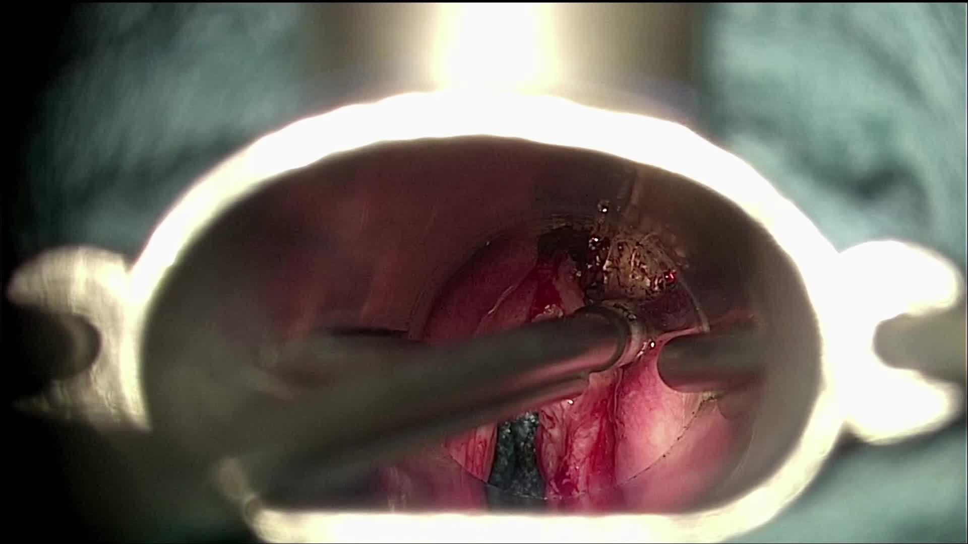 Cordectomy IV right vocal cord