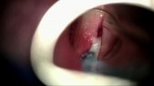 Tumor of the left vocal fold. Leucoplakia. Cordectomy type I/II