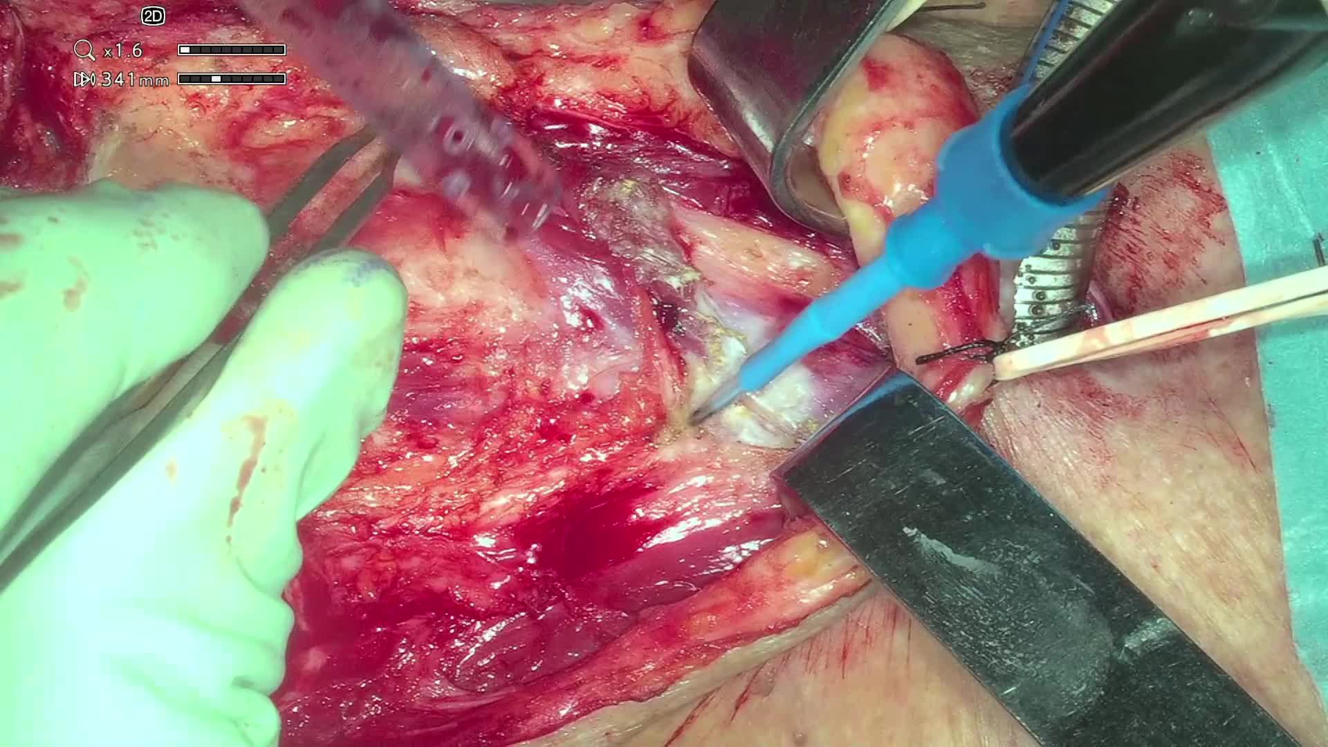 Total laryngectomy due to a non-functional larynx