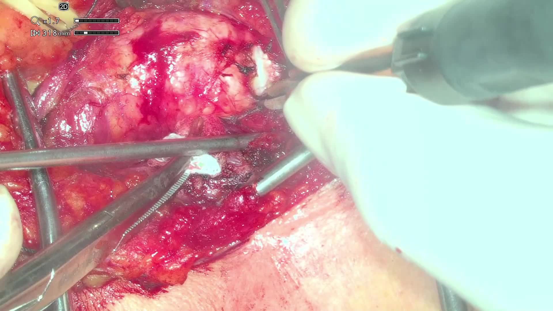 Tracheal resection with a termino-terminal anastomosis
