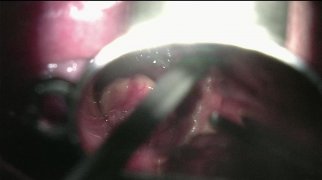 Recurrent respiratory papillomatosis RRP