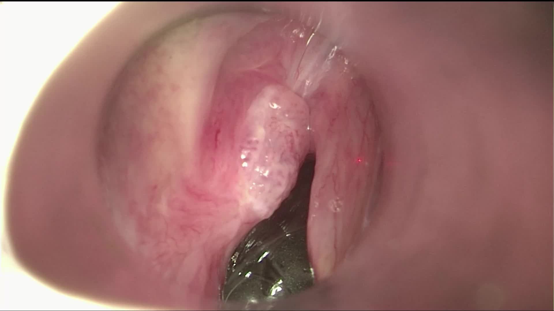 Tumor of the left vocal fold. Cordectomy type III