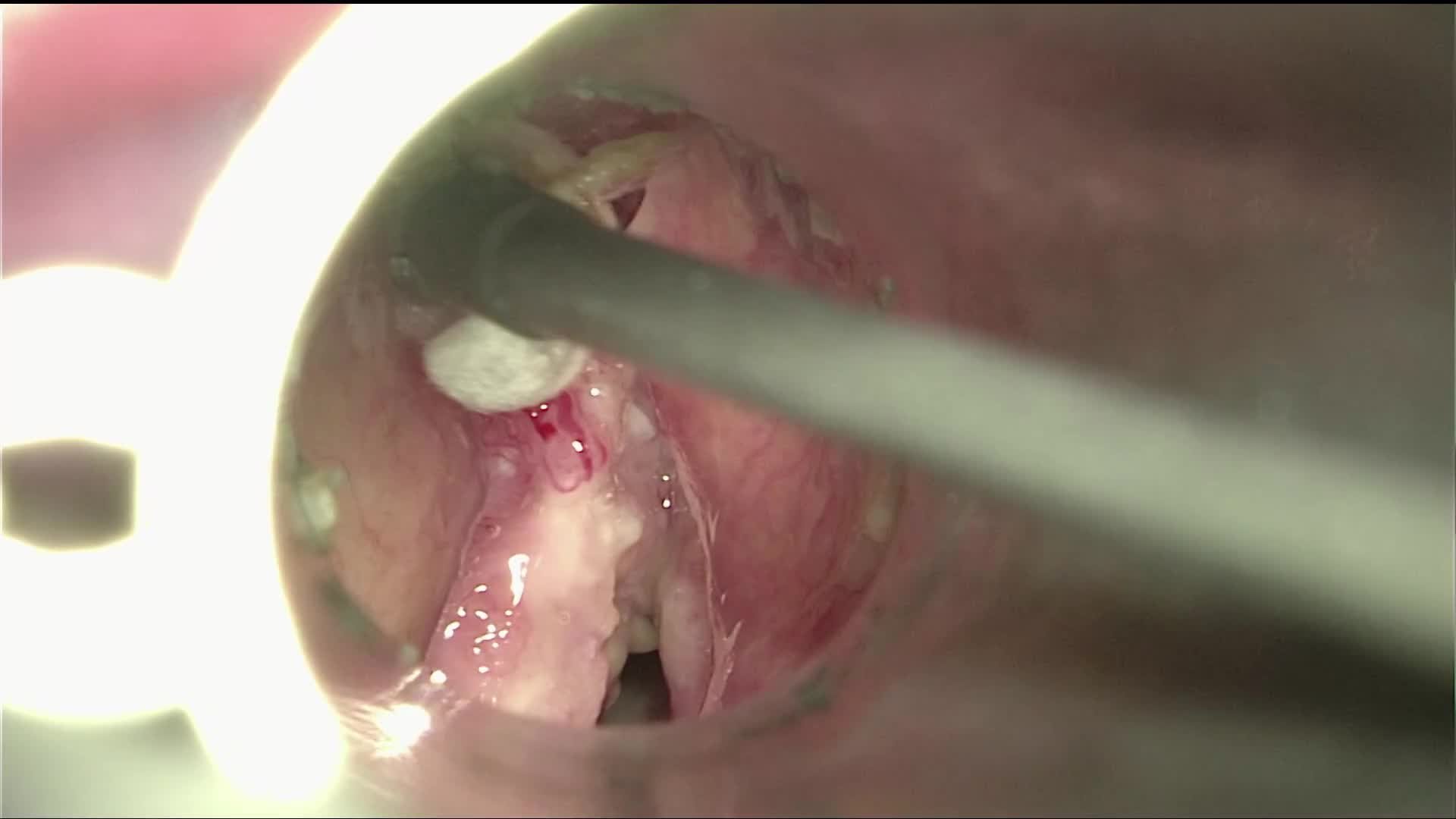 Tumor of the left vocal fold. Cordectomy type V