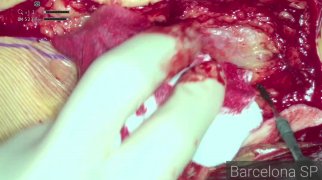 Pectoralis Major Myocutaneous Flap