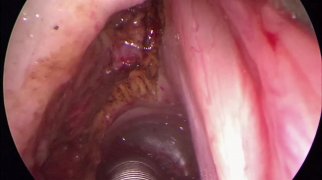 Cordectomy type III of the left vocal cord