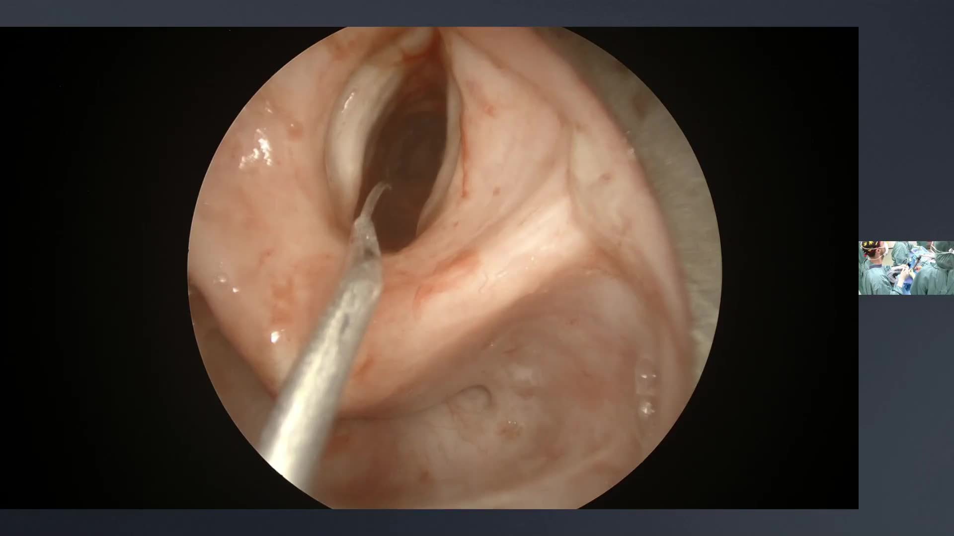 Dilation of a subglottic stenosis in a patient with tracheostomy
