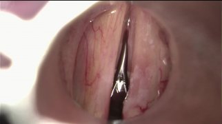 Leukoplakia of the right vocal fold. Cordectomy type I
