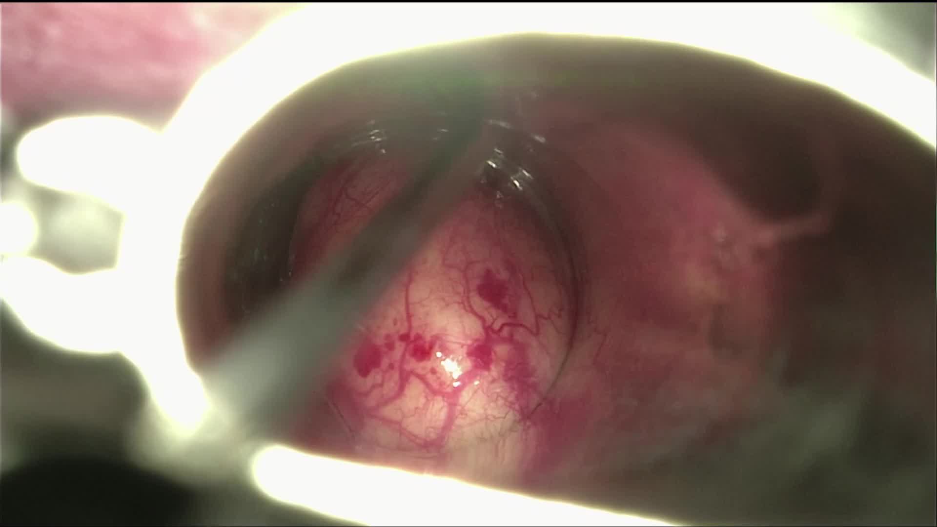 Cyst of the vallecula